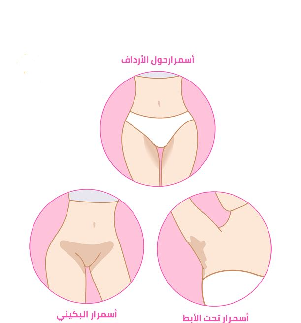 تفتييح المناطق الحساسة العلاج النهائي والفعال ومجرب من الكثير
