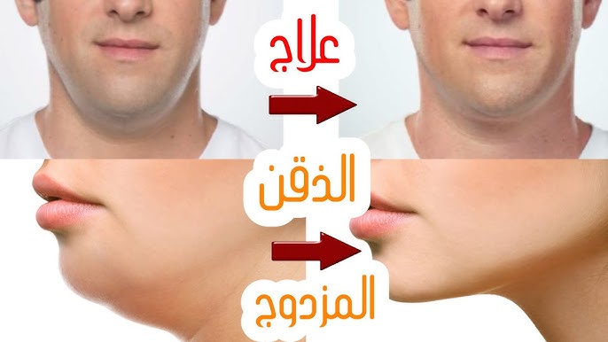 سيروم تنحيف و شد الذقن الاصلي اشتري واحدة ب280الف و احصل على الثانية مجاناا