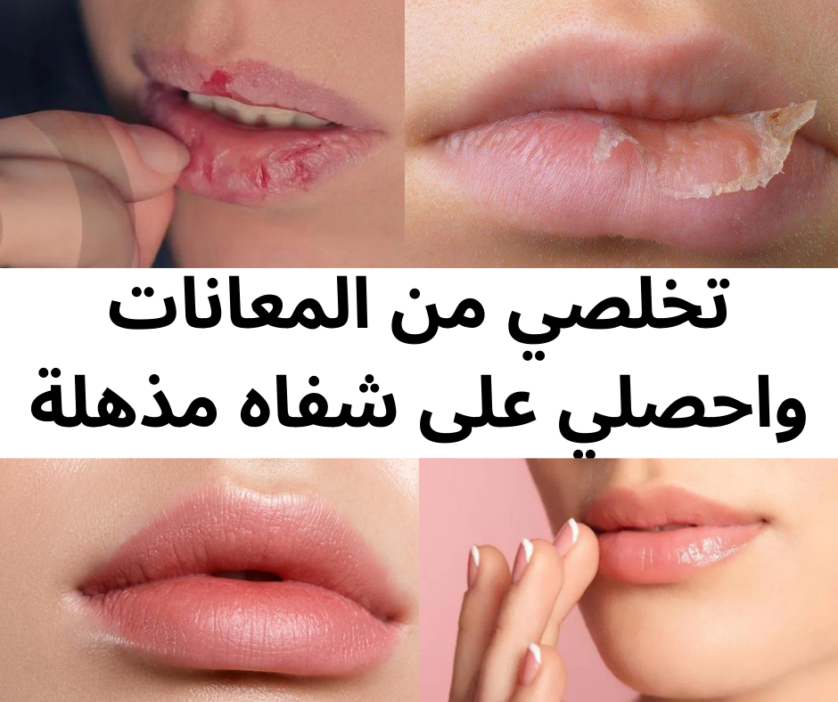 مضخم شفاه 👄 لشفاه اكثر اثارة و انوثة levre BOTOX